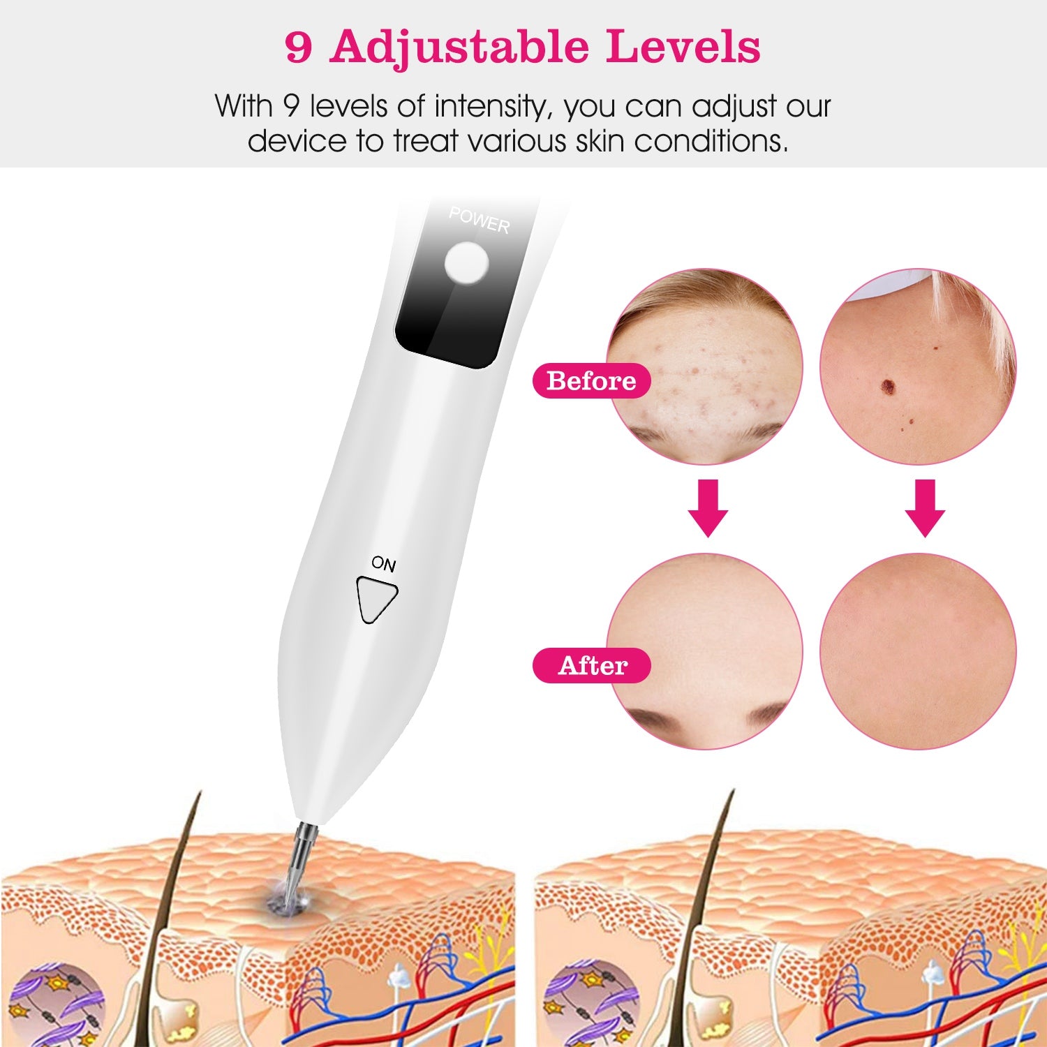 2 PCS Skin Tag Repair Kit Portable Beauty Equipment Multi-Level with Home Usage USB Charging LCD Level Adjustable 12 Replaceable Needles 266924-41